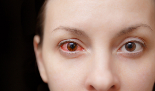 Donna con occhio destro arrossato per congiuntivite allergica